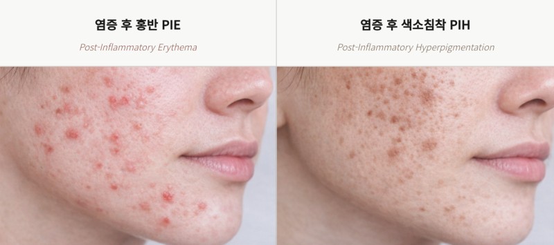염증 후 홍반(PIE)과 염증 후 색소침착(PIH)