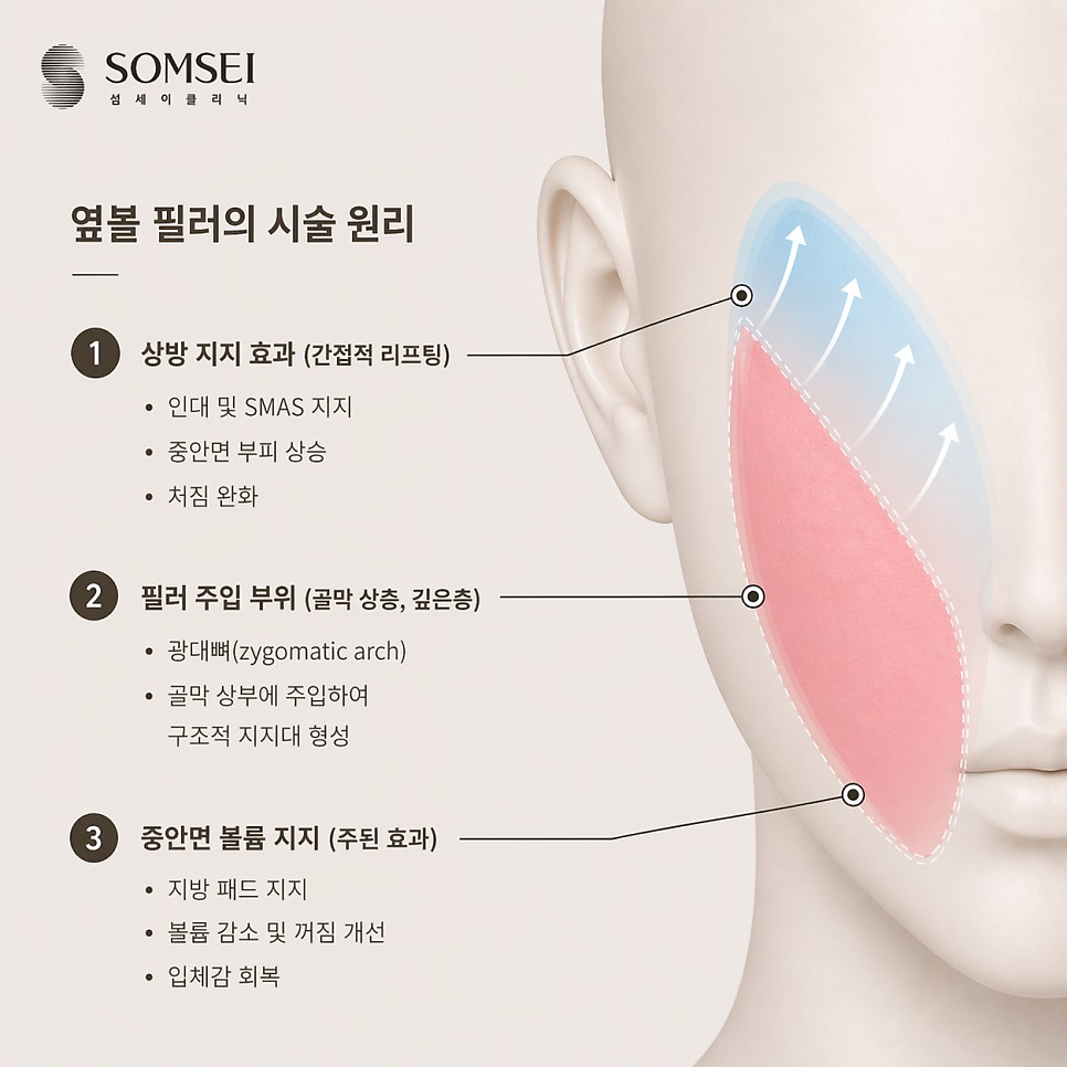 옆볼 필러의 시술 원리