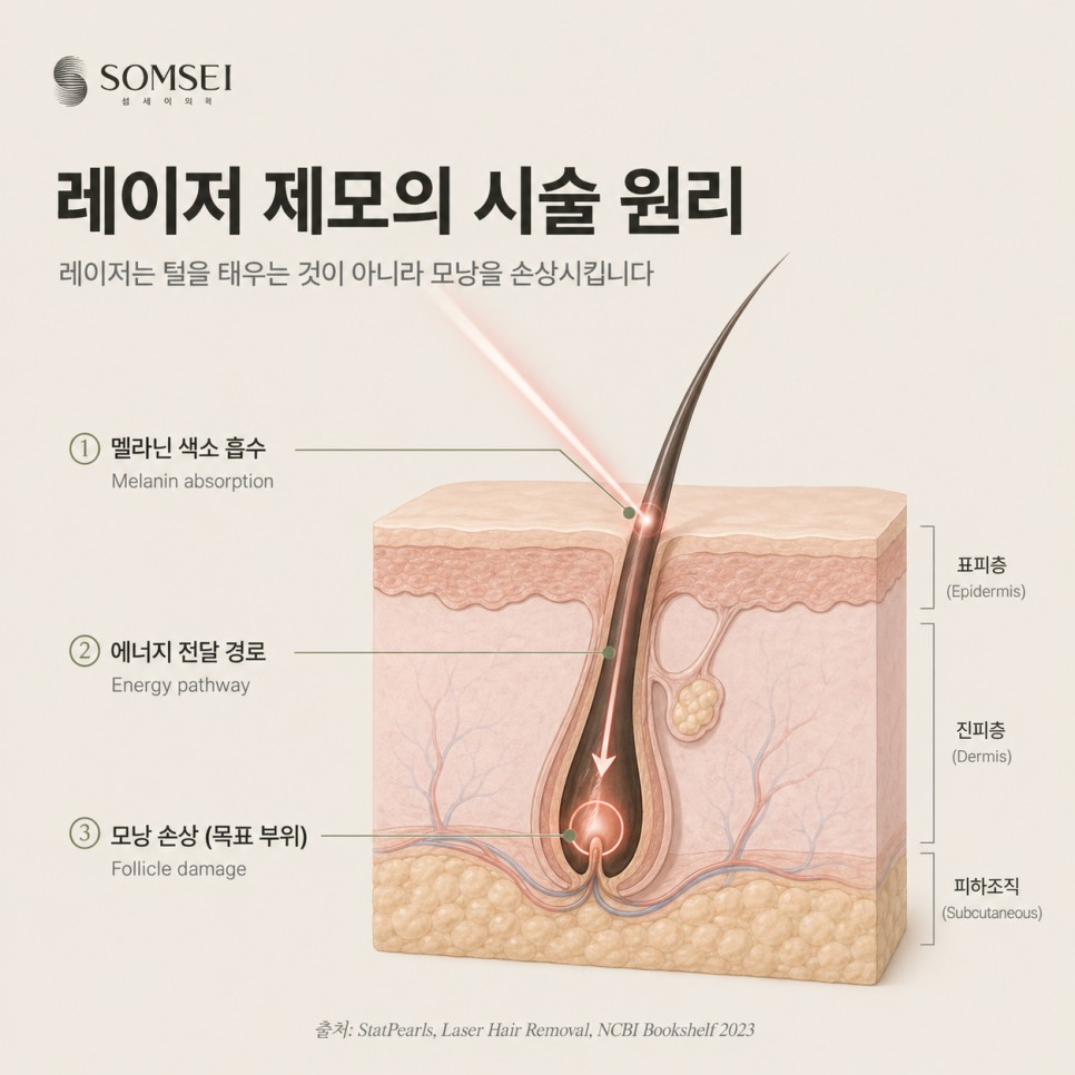 레이저 제모의 시술 원리 도식