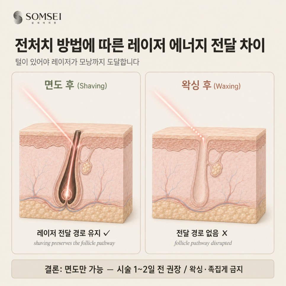 면도 후와 왁싱 후 레이저 에너지 전달 차이 도식