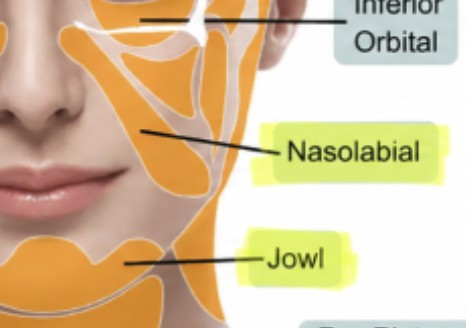 입가 옆(Nasolabial)과 턱선 위(Jowl) 지방 구획