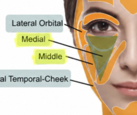 앞볼(Medial)과 볼 중앙(Middle) 지방 구획