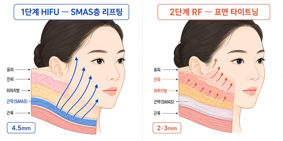 HIFU 다음 RF 시술 순서