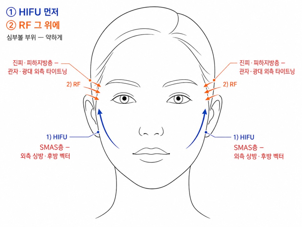 HIFU 먼저 RF 그 위에 시술 순서
