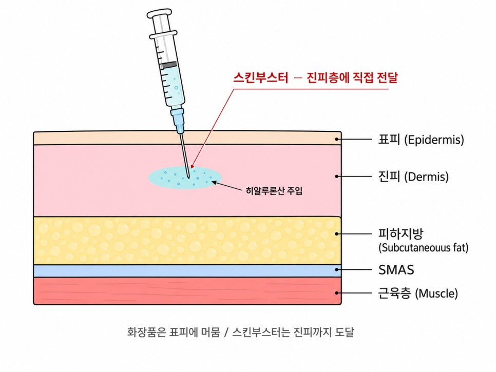 스킨부스터가 진피층에 직접 전달되는 모식도