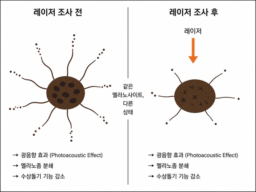 레이저 조사 전후 멜라노사이트 변화