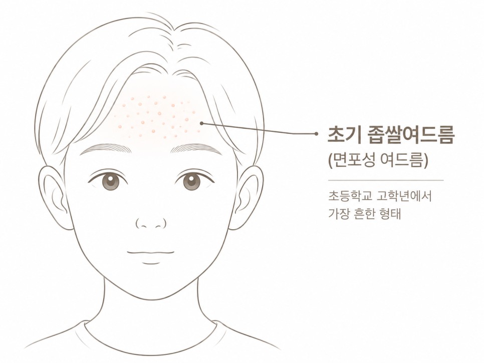 이마의 초기 좁쌀여드름