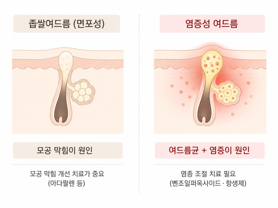 좁쌀여드름과 염증성 여드름의 원인 비교