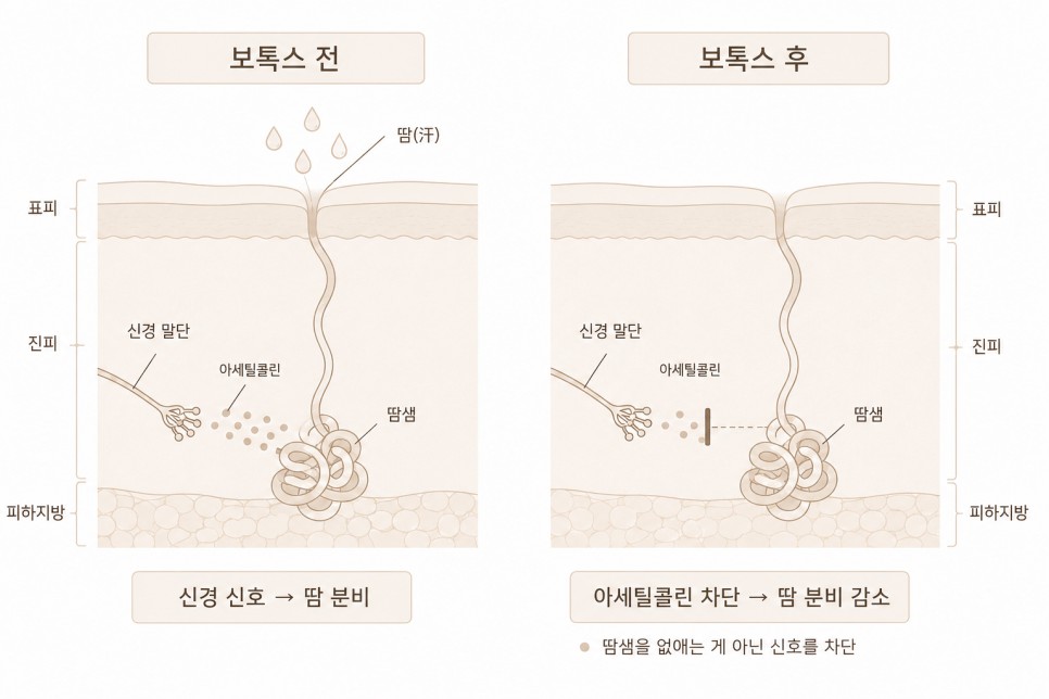 보톡스 전후 땀샘 신경 신호 차단 모식도