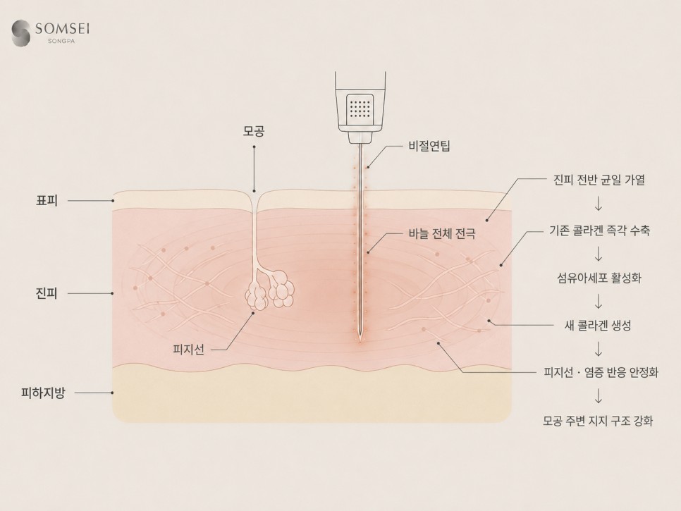 비절연 RF 마이크로니들 작용 원리