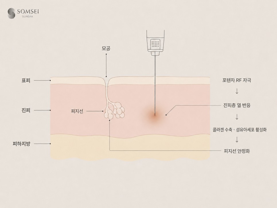 포텐자 미세침이 진피에 RF를 전달하는 단면도