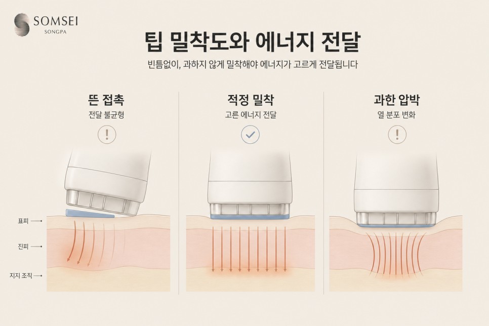 팁 밀착도와 에너지 전달