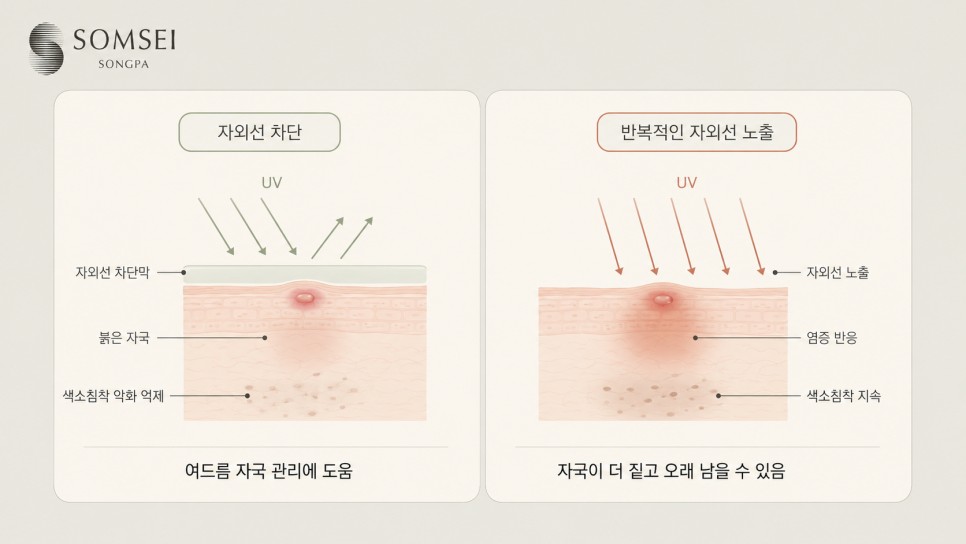 자외선 차단 여부에 따른 여드름 자국 변화 모식도