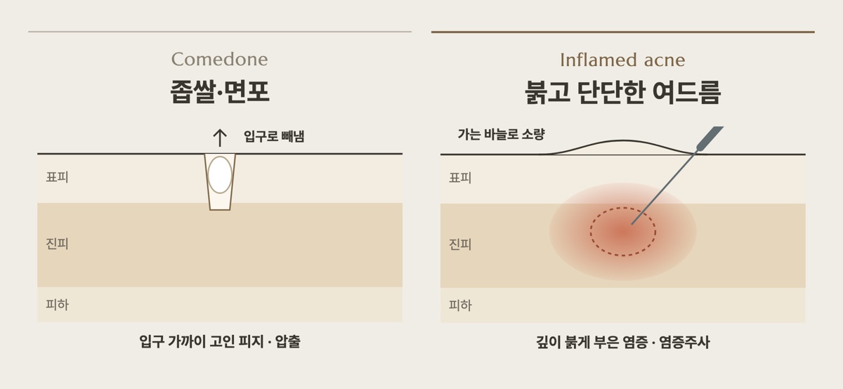 좁쌀·면포 압출과 붉고 단단한 여드름 염증주사 비교