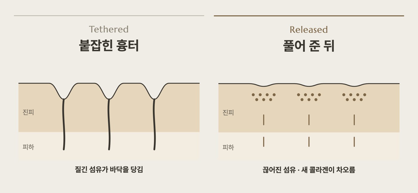 붙잡힌 흉터와 풀어 준 뒤 비교