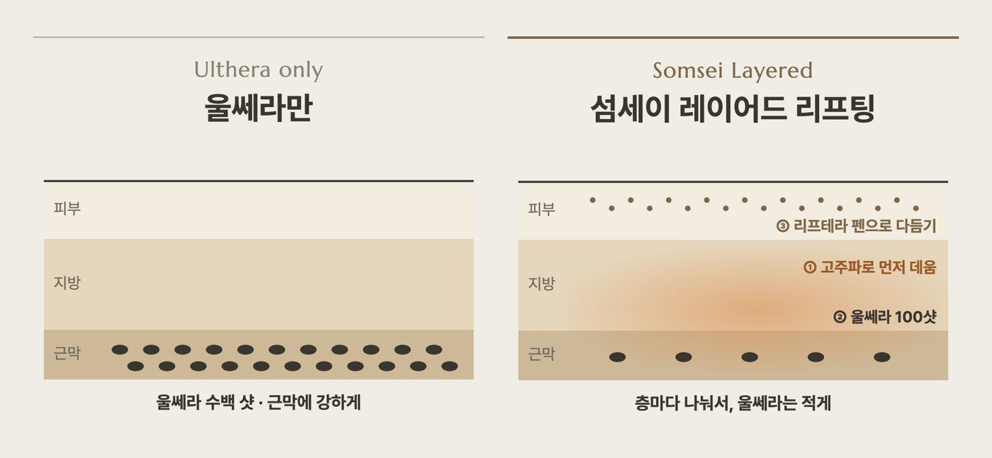 울쎄라만 받을 때와 섬세이 레이어드 리프팅 비교